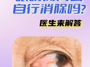 超级胬肉系统真的有效吗？为什么-如何解决眼部胬肉问题？